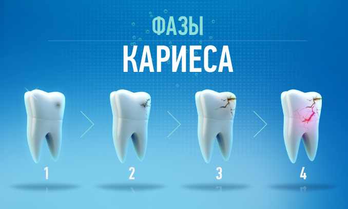 кариес зубов фото стадии как лечат онлайн кариес зубов фото стадии как лечат