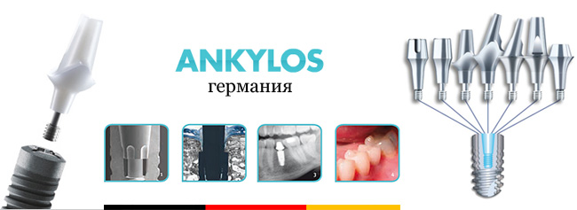 Импланты Ankylos Томск Родительская стоматологический аппарат