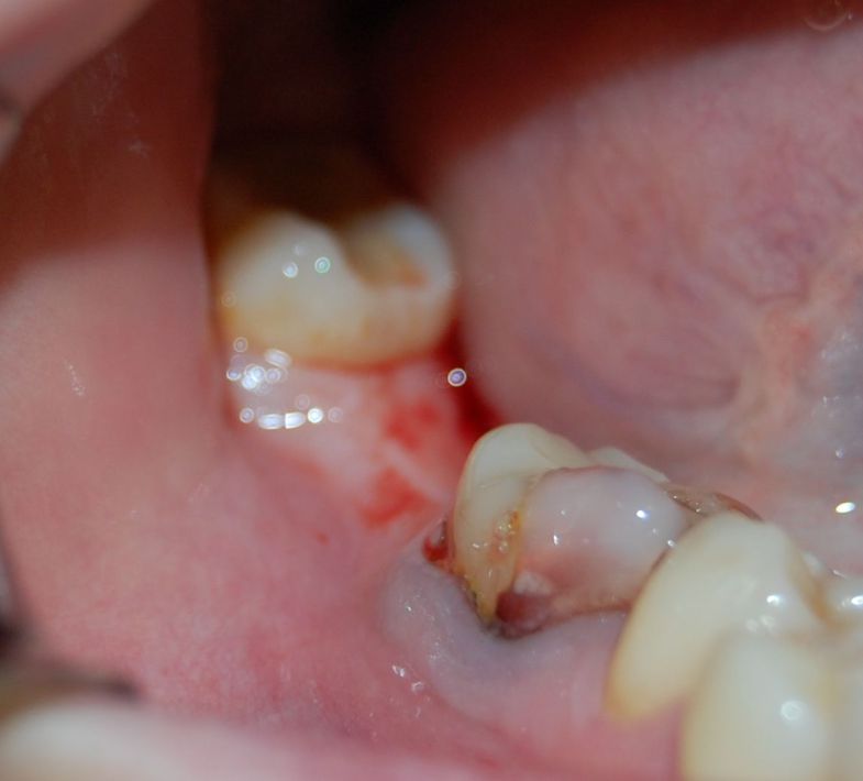 имплантация нижнего зуба