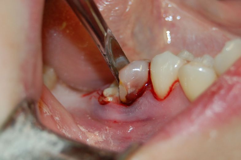 имплантация 6 нижнего зуба