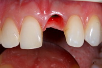 имплантация зубов десна