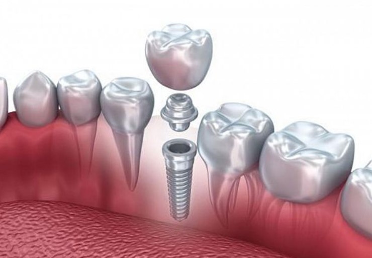 показания и противопоказания к имплантации зубов