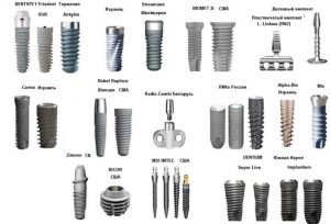 Виды имплантов презентация