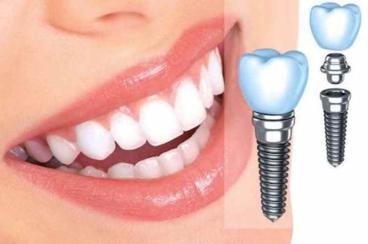Имплантация зубов – вредно или нет